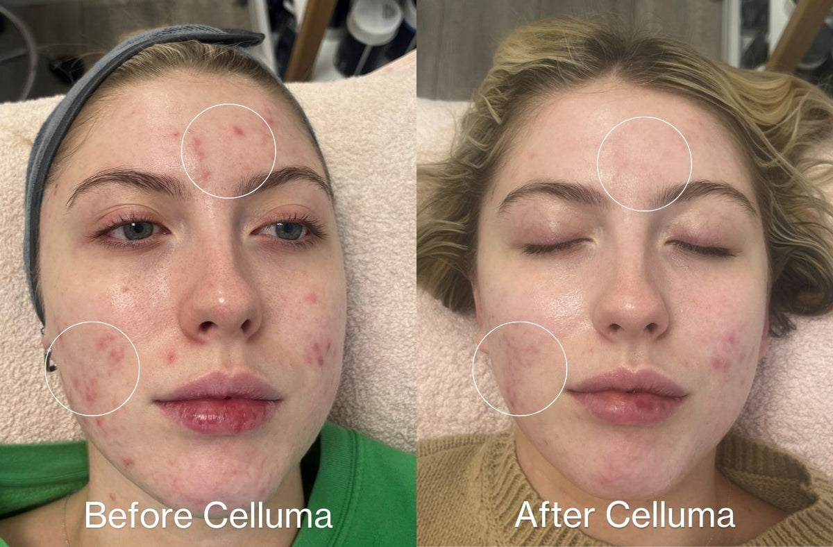 Before Celluma (left side) and After Celluma (right side) showing a woman with enhanced complexion, reduced acne, and overall improvement of skin appearance with blue light and red light therapy. Protocol was 3x per week for 4 weeks.