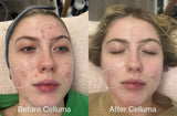 Before Celluma (left side) and After Celluma (right side) showing a woman with enhanced complexion, reduced acne, and overall improvement of skin appearance with blue light and red light therapy. Protocol was 3x per week for 4 weeks.