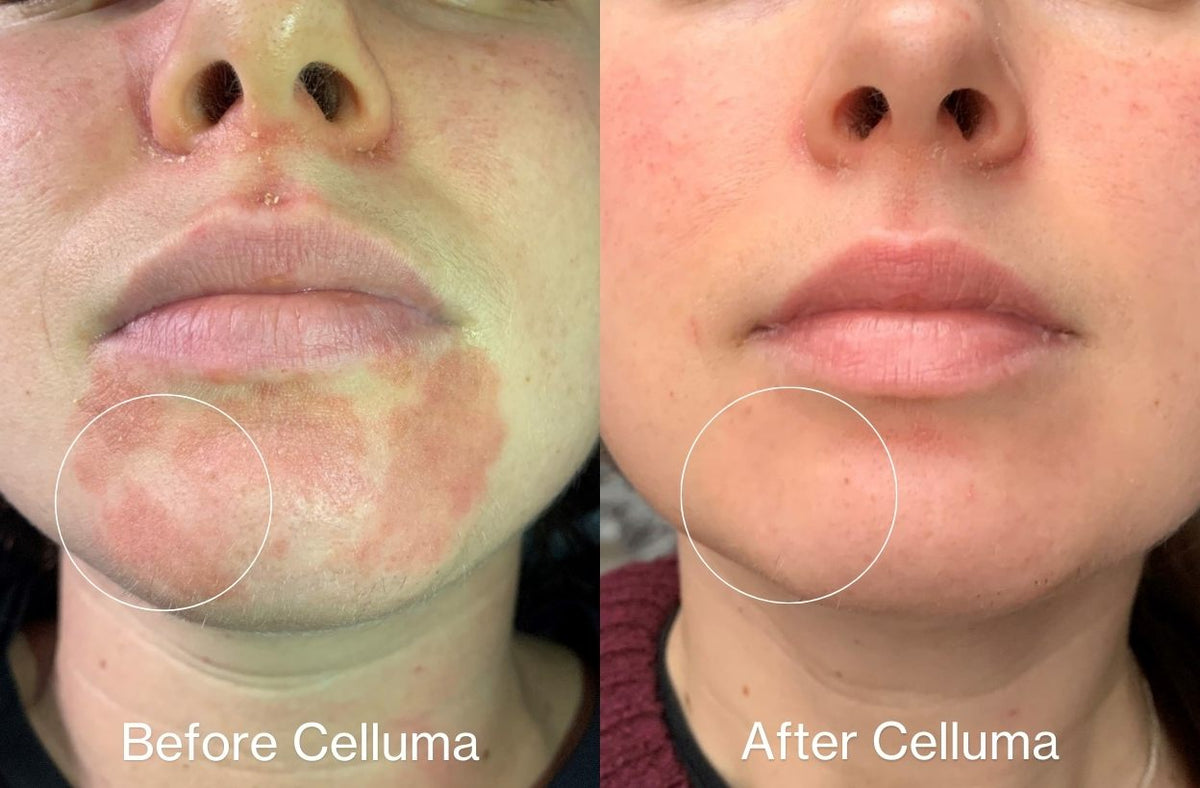 Before and after images of a women's chin showing significantly reduced redness and inflammation following 10 days of treatment with LED light therapy. Protocol was 30 minutes, once a day for 10 days. No other modalities used.