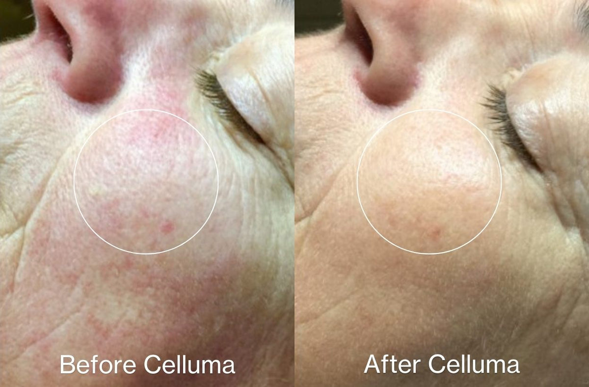 Before and after images showing the positive effects of LED red light therapy to treat wrinkles, redness, fine lines and other signs of aging. Text over images: Before Celluma (left) and After Celluma (right).