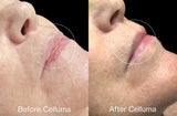 Before Celluma (left) and after Celluma (right) showing side profile of a woman's face with reduced fine lines and wrinkles along with improved texture of the skin red, near-infrared, and blue light therapy. Protocol was 30 minutes, 3 times per week, for 4 weeks. After photo was taken 8 weeks post treatment.